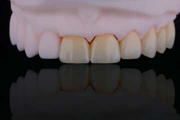 High-quality six dental crowns made of zirconium for fixation to the teeth of upper jaw. © gorynvd
