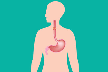Healthcare infographic depicting esophageal cancer symptoms and anatomy. green background