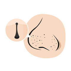 Nose with blackheads, large pores on the nose, on a white background.
