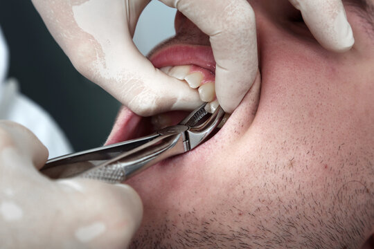 Jemandem den Zahn ziehen