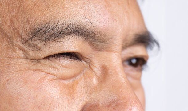 Senior man eye strain after for long stretches at digital screens.