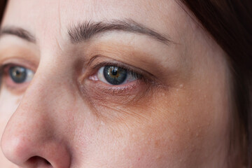 Close-up portrait of young caucasian woman's face with big dark pigment spot on the skin around the...