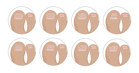 Podiatrist applying different kinds of metallic threads for ingrown toenail correction