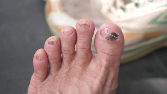 Close-up of a bruised and damaged toenail from running injury, sports exercise trauma