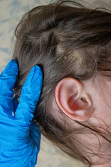 Examination of the scalp, principles of hygiene. Dandruff in the hair. Peeling of the scalp. seborrhea. Macro photography.
