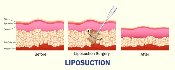 educational cutout diagram of human skin showing the process of Liposuction through lipo fat removal procedure. Healthcare and Medical concept
