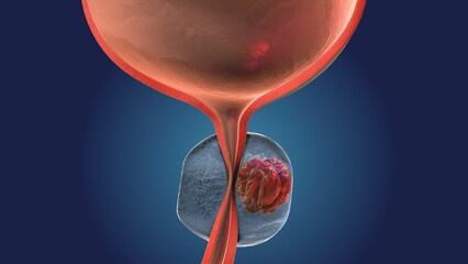 Bladder Function Impacted by Prostate Gland Cancer