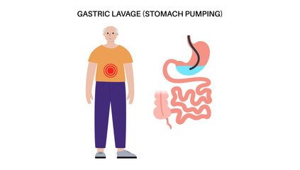 Stomach wash gastric lavage