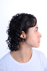 Side profile of a young woman showing signs of acne and skin texture. Neutral expression reflects a dermatological consultation or concern about skin health.

