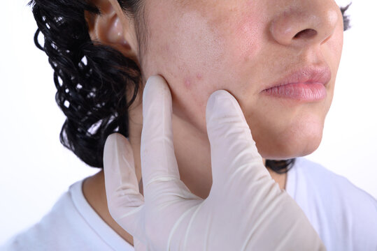 Dermatologist examining female patient with acne, inflamed facial skin, blemishes, pimples, and skin imperfections during medical skincare consultation with gloves in clinical environment