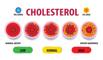Cholesterol in artery, health risk , vector design