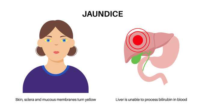 Jaundice yellow skin