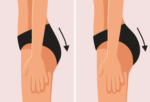 Buttock Augmentation Surgery Before and After Vector Illustration. Results of the transformation after a cosmetic procedure called bbl 

