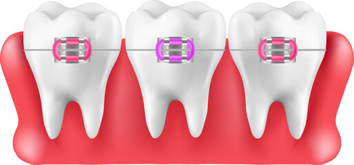 Installing braces on teeth, straightening crooked bites. Vector illustration