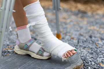 Little caucasian girl walking outdoor with plaster bandage on foot. Bone fracture foot and leg on...