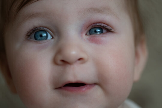 Close up of baby with bacterial purulence conjunctivitis, also known as pink eye. Eye infection.