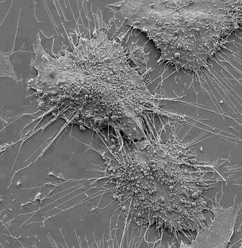 Bone cancer cells, SEM