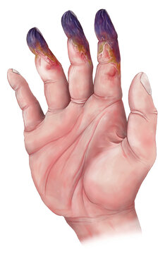 Deep frostbite of a human hand, illustration