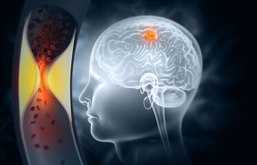 Human brain cholesterol blockage, Stroke, Atherosclerosis. carotid artery disease. 3d illustration.