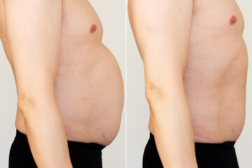 Comparison of adult man's body before and after slim. Man with belly with excess fat before and...