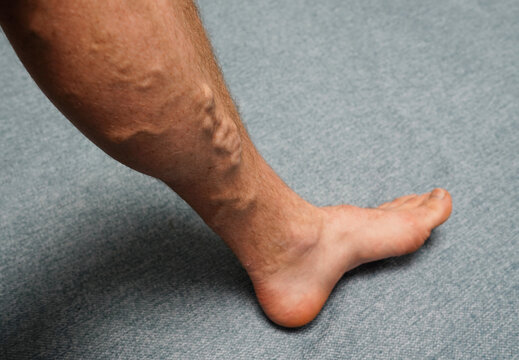 Varicose veins. Phlebology and DVT. Varicose veins on leg of man. Varicosity on legs, spider veins, edema, health illness concept. Phlebeurysm and thrombophlebitis of veins. Phlebology concept.