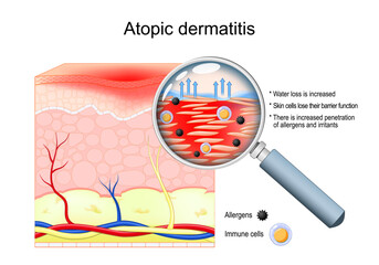 Atopic dermatitis. Close-up of Cross-section of human skin. Eczema