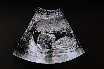 An ultrasound of a human fetus during the 16th week. Ultrasound of a child baby in the womb. Fetus...