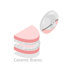 3D Isometric Flat Vector Illustration of Dental Teeth Braces Types, Orthodontic Options for Teeth Straightening. Item 2