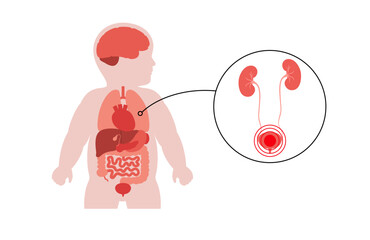 Kidney diseases in a child