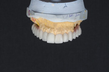 In dental implant surgery, the All-on-Four, All-on-4, and All-on-X treatments involve placing full-arch dental prostheses on cylindrical titanium implants applied to the upper jaw. Dental before after © UniqDream