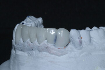 Glass ceramic or zirconium porcelain crowns. Dental bridge crown treatment. Aesthetic smile design treatment in dental dentistry.  Dental Laminate veneers, smile design.   © UniqDream