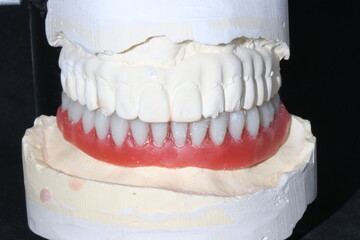 In dentistry, dental implant treatment involves placing a full arch dental prosthesis on implants. The process includes dental before and after images and X-ray images. smile makeover.