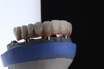 In dentistry, dental implant treatment involves placing a full arch dental prosthesis on implants. The process includes dental before and after images and X-ray images. smile makeover. © UniqDream