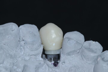 Prosthetic tooth treatment with intraosseous dental implants via jaw surgery in dental dentistry. Tooth loss implant treatment. Smile makeover.  © UniqDream