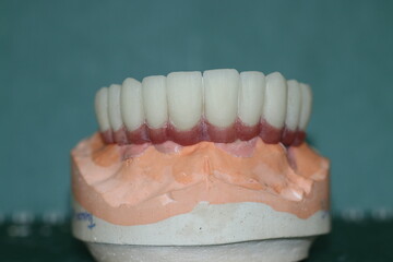 In dentistry, dental implant treatment involves placing a full arch dental prosthesis on implants. The process includes dental before and after images and X-ray images. smile makeover.