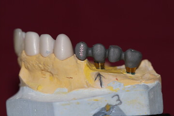 Prosthetic tooth treatment with intraosseous dental implants via jaw surgery in dental dentistry. Tooth loss implant treatment. Smile makeover.  © UniqDream