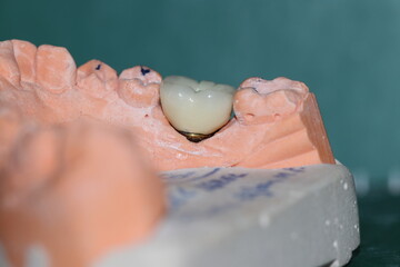 Prosthetic tooth treatment with intraosseous dental implants via jaw surgery in dental dentistry. Tooth loss implant treatment. Smile makeover.  © UniqDream