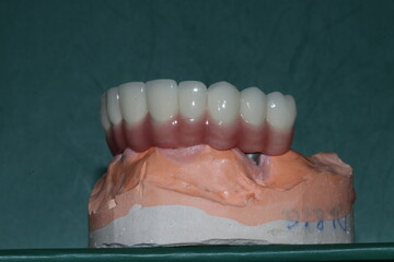 In dentistry, dental implant treatment involves placing a full arch dental prosthesis on implants....