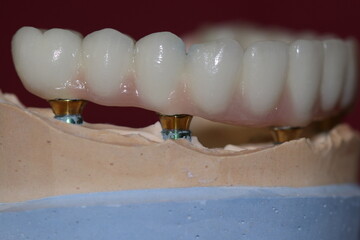 In dentistry, dental implant treatment involves placing a full arch dental prosthesis on implants. The process includes dental before and after images and X-ray images. smile makeover.