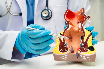 Asian doctor with rectum and hemorrhoid human anatomy model at hospital, inflamed vascular...