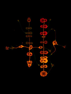 Karyotype of Patau syndrome also known as trisomy 13, is a genetic disorder caused by the presence of all or part of a third copy of chromosome 13.