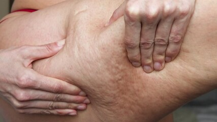 Close-Up of Woman's Thigh with Stretch Marks and Cellulite, Body Care, Skin Health, and Self-Acceptance Concept