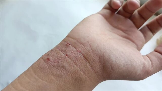 Atopic dermatitis on the wrists. Allergic skin rashes. Dermatological diseases. Itchy skin. Inflammation and cracks on the skin .