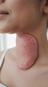 Close-up of woman's neck with swollen thyroid gland indicating potential health issue or medical condition, thyroid enlargement.
