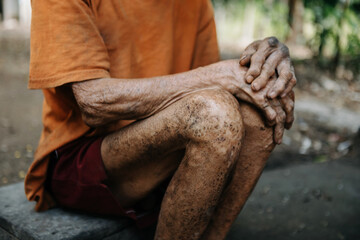 Close up of male wrinkled hands, old man is wearing  skin disease and anxiety Copy space.