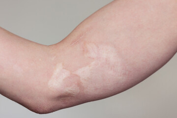 Close-up of the arm of an adult Caucasian man with a big scar on the skin after a burn.