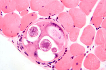 Trichinella spiralis larvae in muscle tissue, photomicrograph showing encysted parasites. Causes...