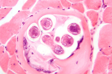 Trichinella spiralis larvae in muscle tissue, photomicrograph showing encysted parasites. Causes trichinosis, a parasitic infection from undercooked meat.