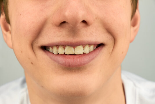 Young smiling boy showing natural, slightly yellow teeth and dimples, captured in soft lighting against a neutral background.