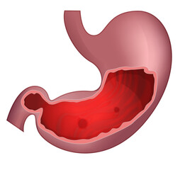 Obraz premium Peptic Ulcer - Stomach Ache - Illustration